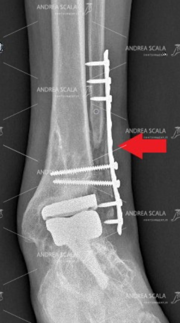 La RX anteriore mostra che il perone non si è ri-attaccato. La freccia indica che la placca e le viti tengono insieme alcuni frammenti dell’ex perone. La caviglia è molto dolorosa ed instabile.