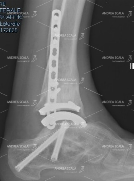 la RX laterale mostra una protesi impiantata per via laterale
