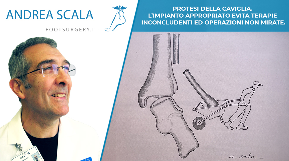PROTESI DELLA CAVIGLIA. L’impianto appropriato evita terapie inconcludenti ed operazioni non mirate.