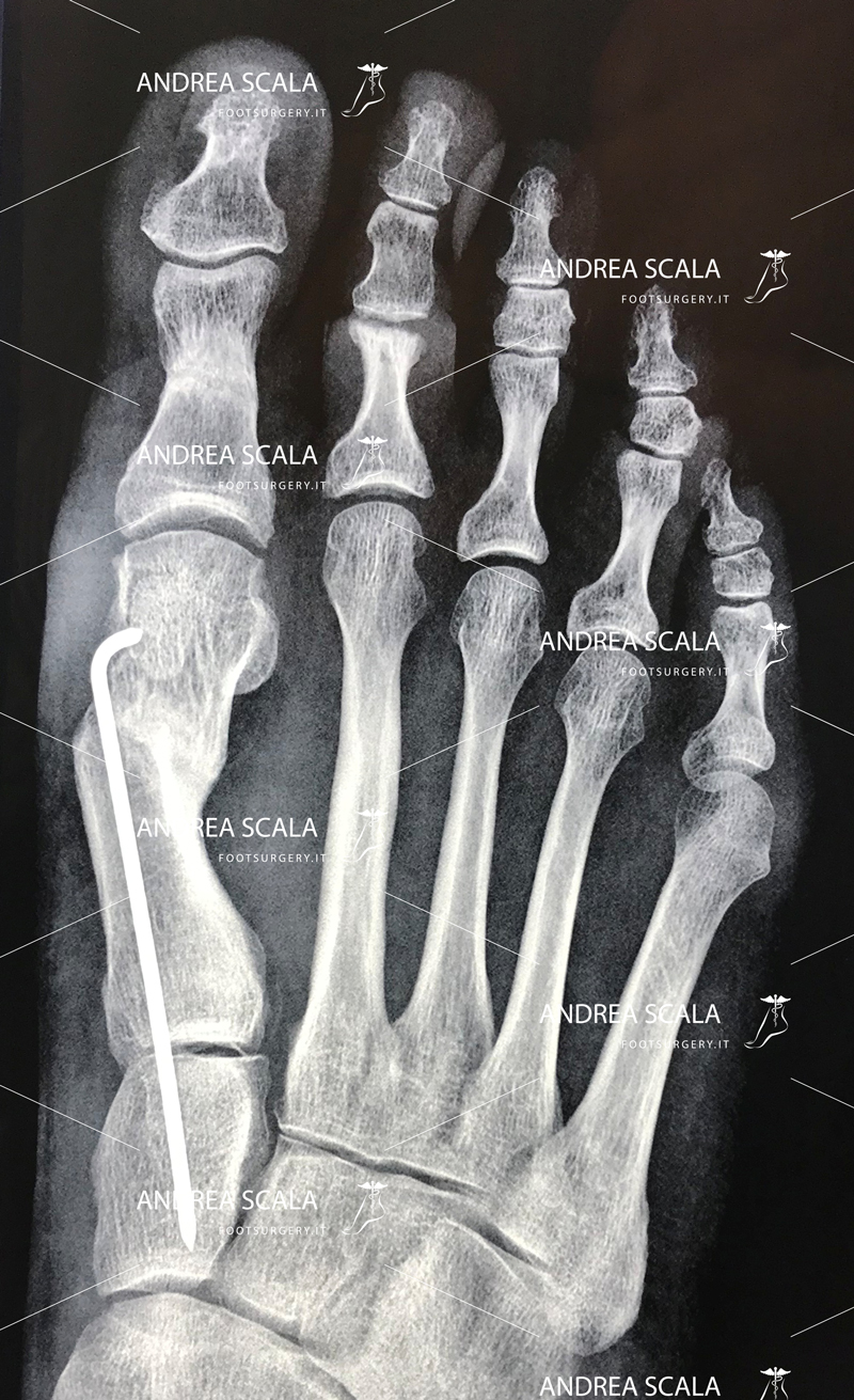 alluce valgo radiografia intervento