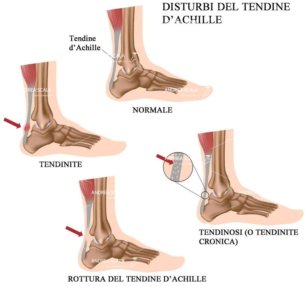 disturbi tendine di achille