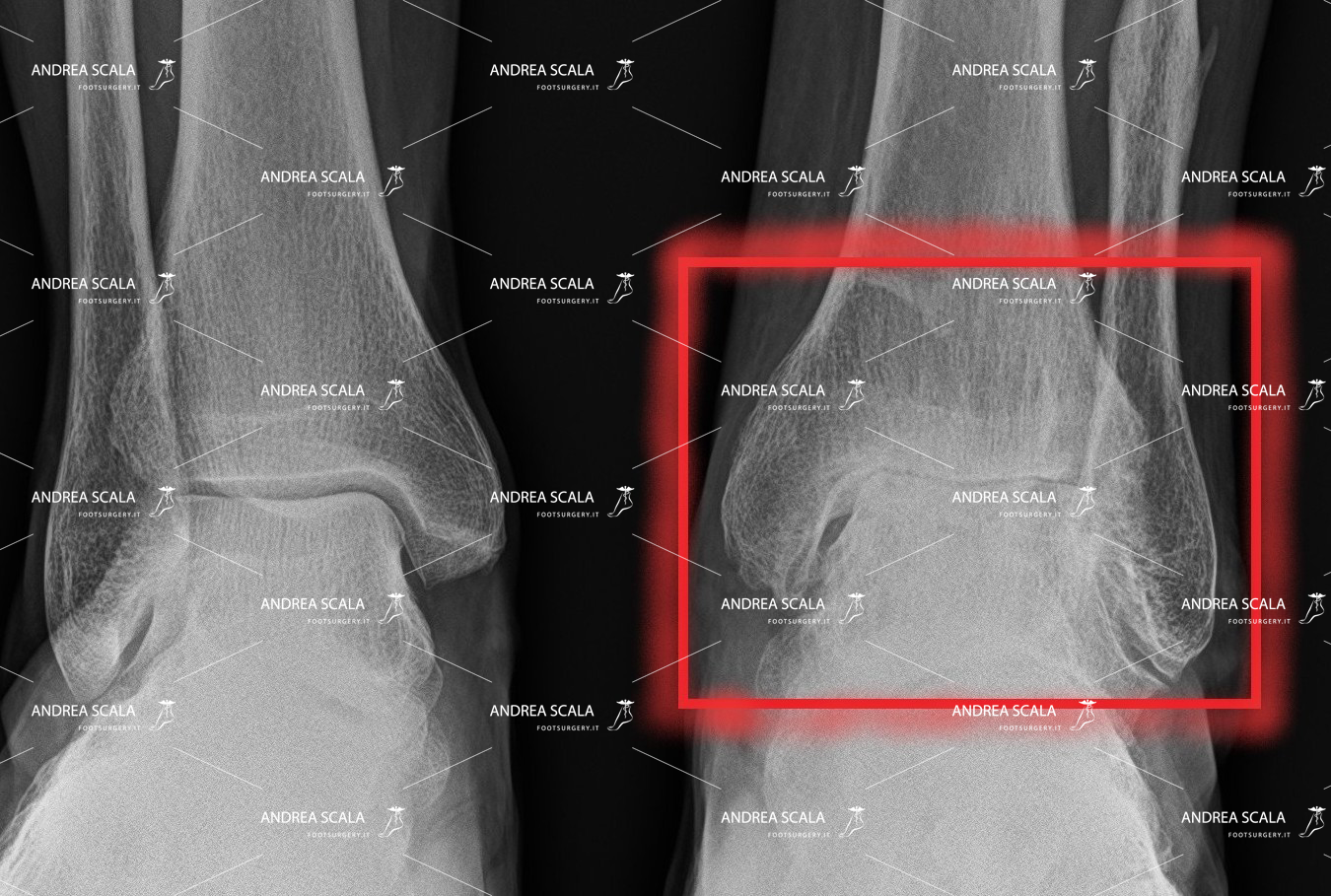 protesi di caviglia in caso di artrosi