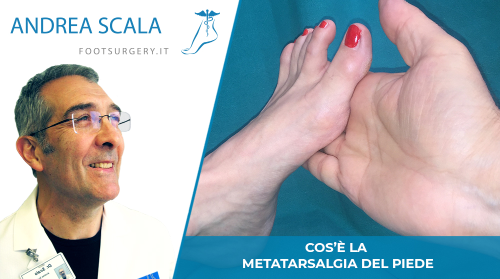 Cos’è la metatarsalgia del piede?