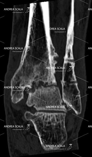 radiografia anteriore protesi caviglia