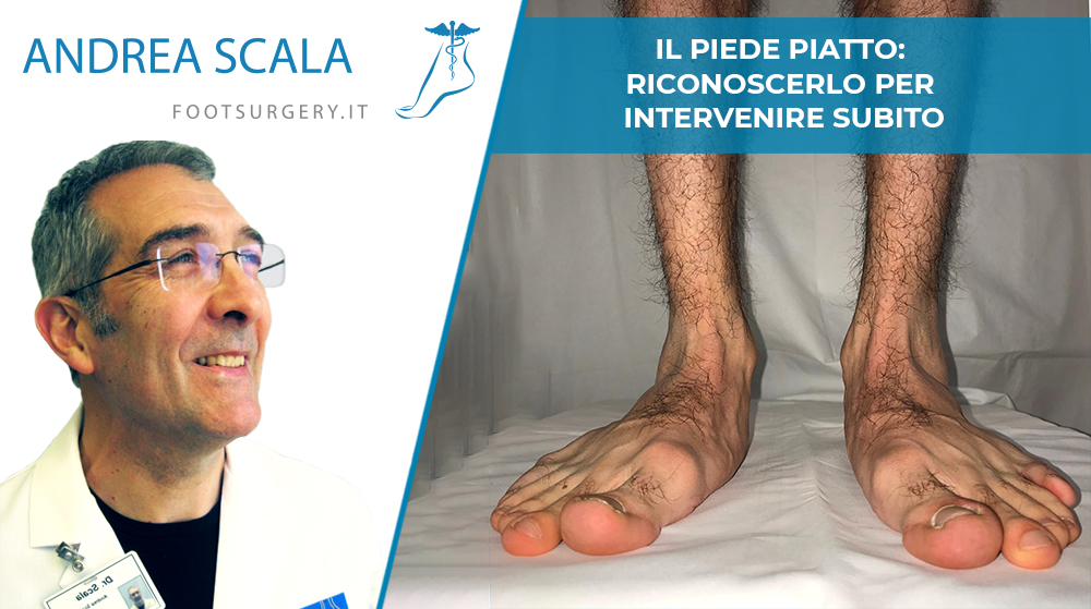 Il Piede Piatto: riconoscerlo per intervenire subito
