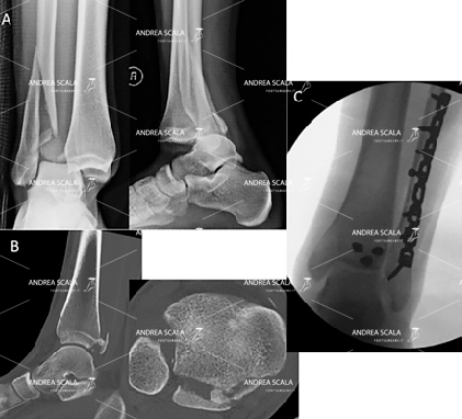 protesi di caviglia