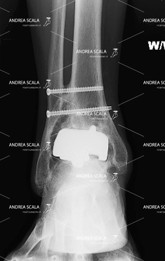 protesi di caviglia