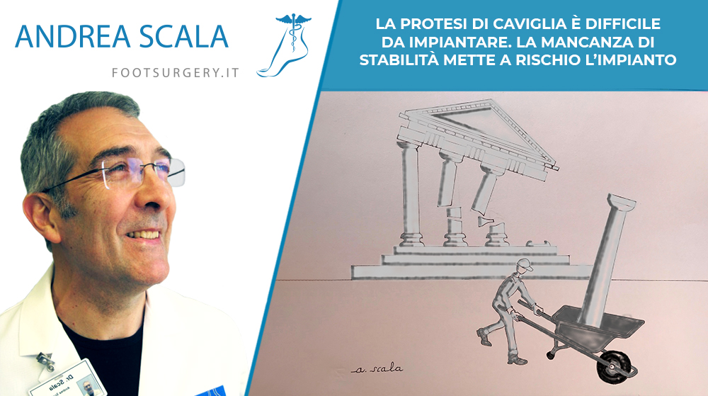 La protesi di caviglia è difficile da impiantare. La mancanza di stabilità mette a rischio l’impianto