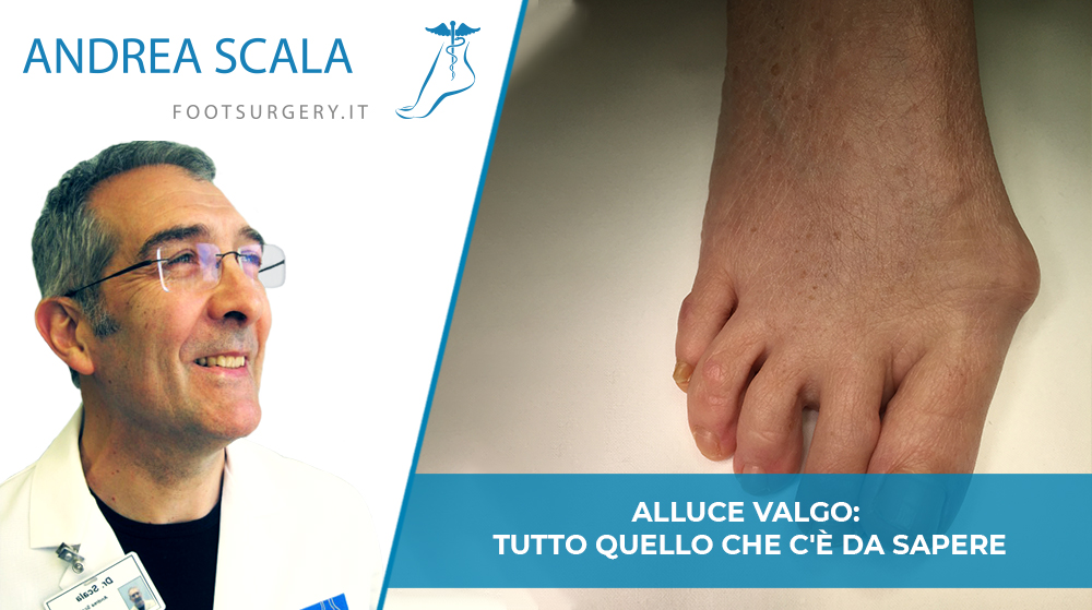 Alluce valgo: tutto quello che c’è da sapere