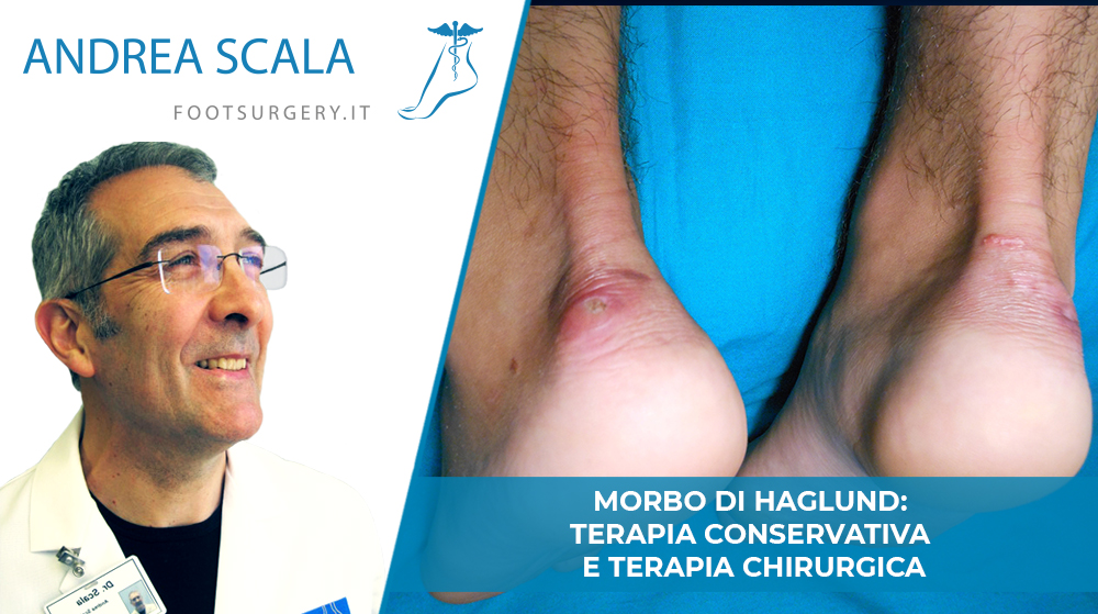 Malattia di Haglund: terapia conservativa e terapia chirurgica