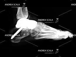 La RX mostra l’astragalo ricostruito senza 3D negli anni passati.