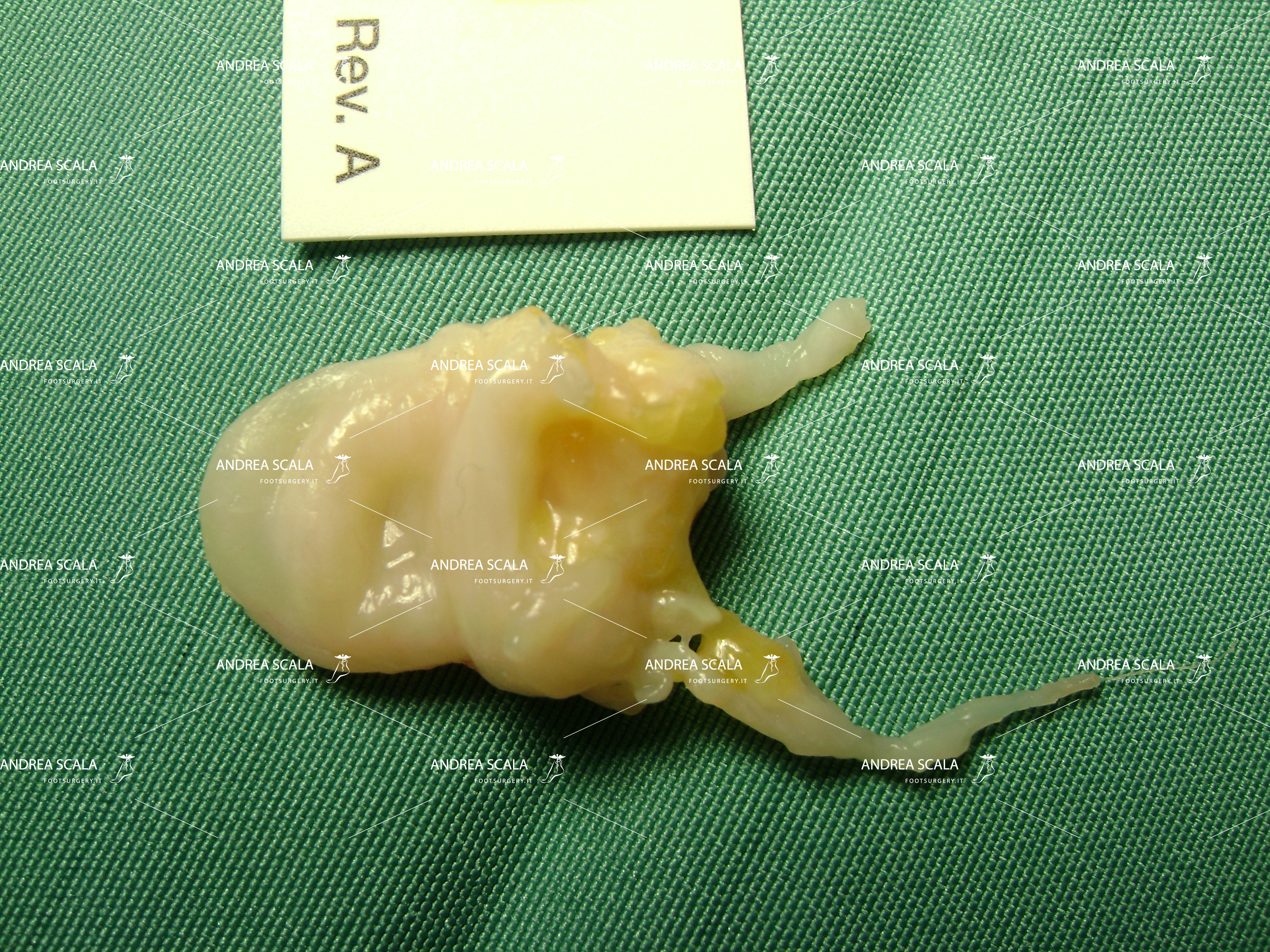Neuroma di Morton