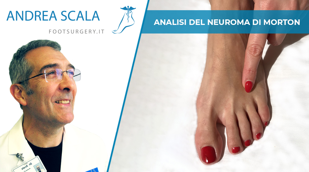 Analisi del Neuroma di Morton