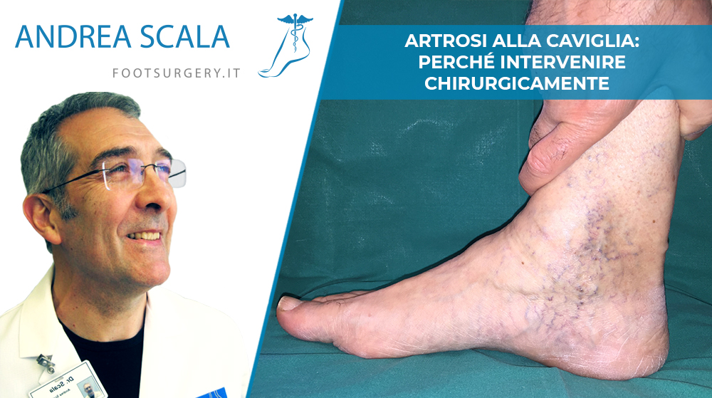 Artrosi alla caviglia: perché intervenire chirurgicamente