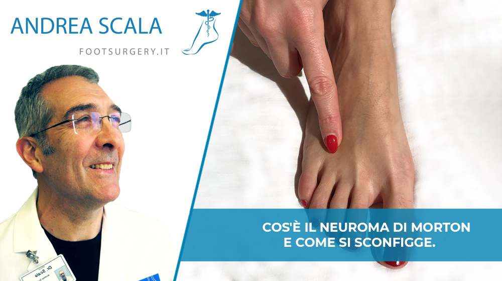 Cos’è il Neuroma di Morton e come si sconfigge