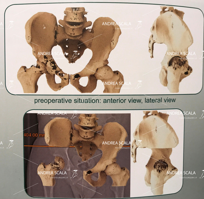 Ricostruzione 3D anca PELVI TUMORE 3D