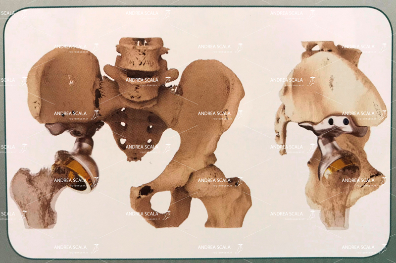 protesi anca da impiantare PELVI-progetto 3d