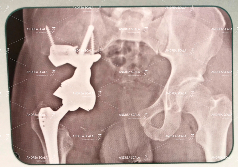 protesi anca impiantata PELVI-RX 3d