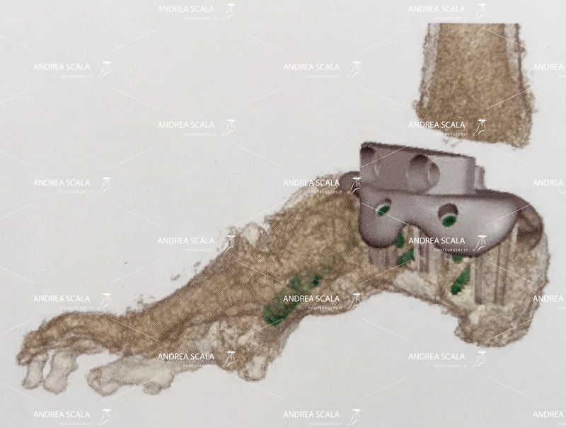 progetto ricostruzione caviglia PIEDE-progetto 3D