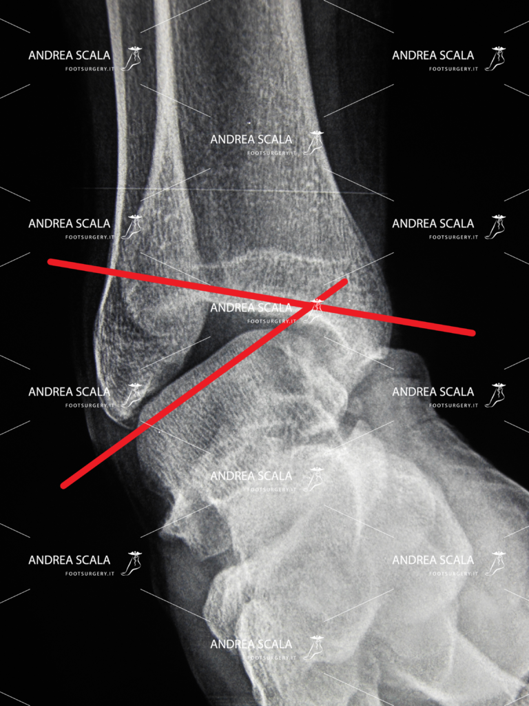 Rxgrafia caso di grave instabilità della caviglia