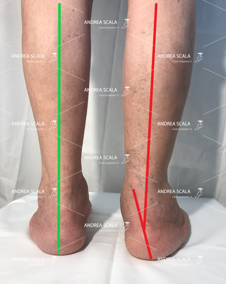 cedimento del calcagno in valgismo