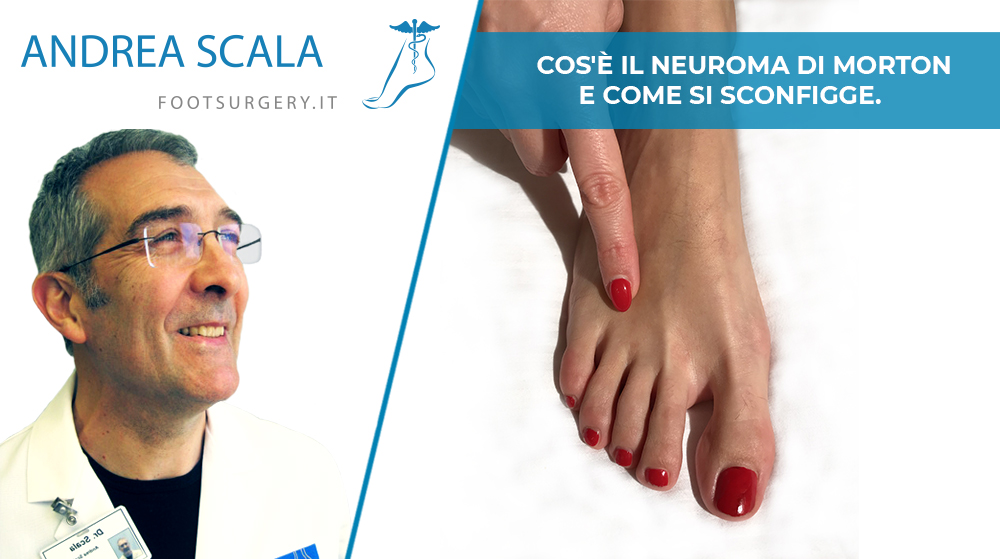 Cos'è il Neuroma di Morton