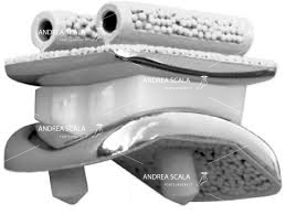 protesi con polietilene mobile libero di muoversi tra la componente tibiale e l’astragalo