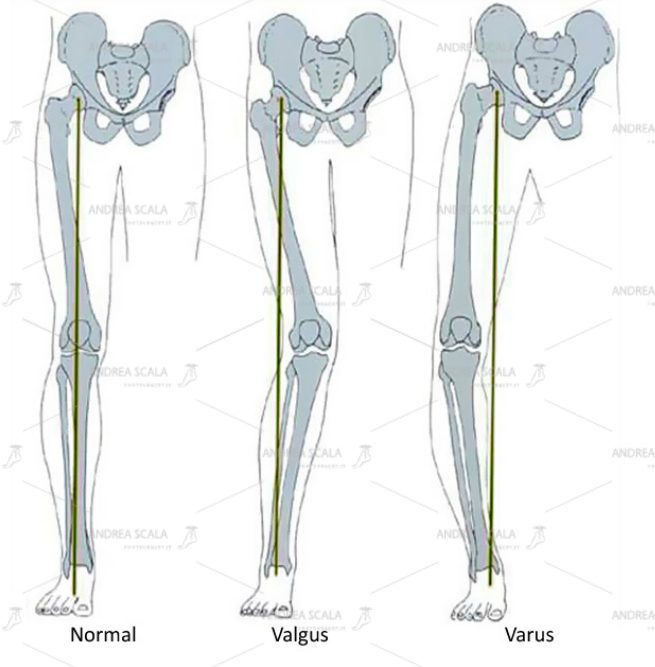 Lo schema mostra i diversi quadri clinici dell’arto inferiore che il Chirurgo deve affrontare arto in asse, deviato in valgo, deviato in varo.