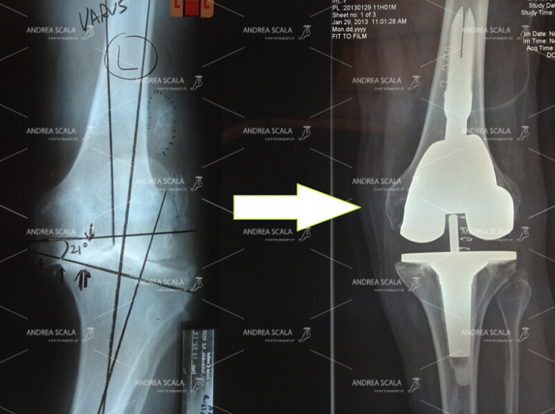 RX di ginocchio varo e RX del risultato ottenuto con la protesi di ginocchio.