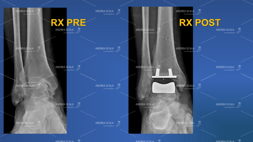 Le radiografie mostrano la visione anteriore pre e post operatoria della caviglia.
