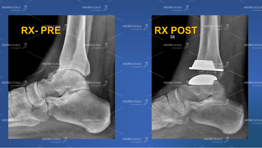 Le radiografie mostrano la visione laterale pre e post operatoria della caviglia.