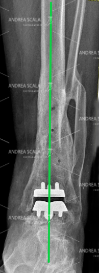 Rxgrafia post operatoria di una protesi della caviglia che mostra il corretto allineamento dell’arto e il corretto montaggio delle componenti della protesi di caviglia.
