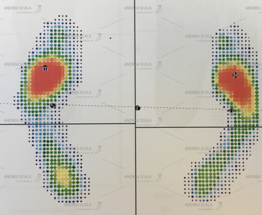 Esame baropodometrico in paziente che presenta metatarsalgia