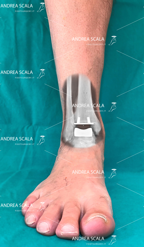 Esempio di protesi di caviglia ben allineato e ben integrato.
