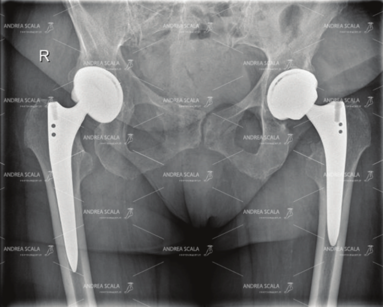 RX di protesi d’anca bilaterale