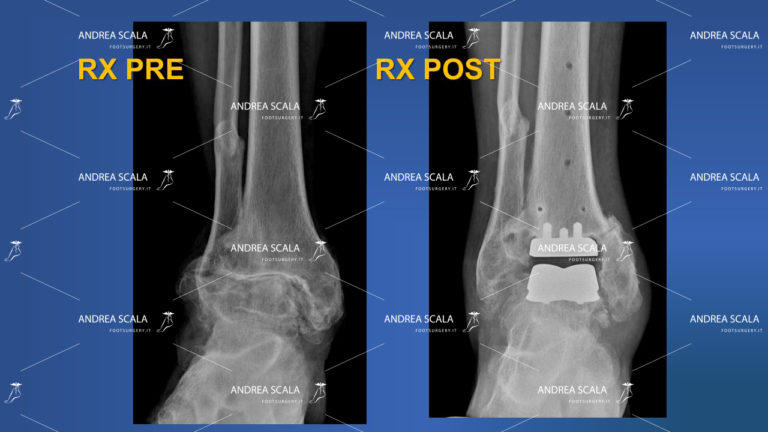 Radiografia anteriore prima e dopo la protesi dei caviglia