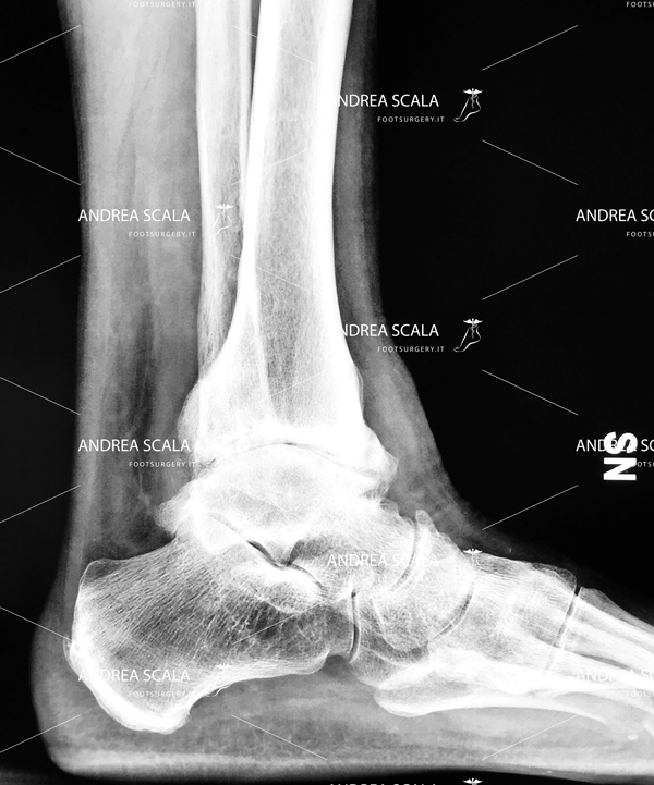 Radiografia di artrosi deformante della caviglia