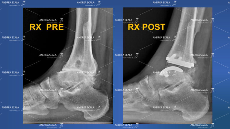 Radiografia laterale prima e dopo la protesi dei caviglia