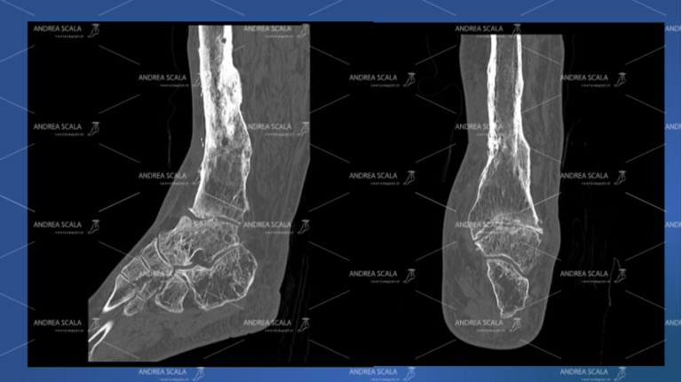 dettaglio dell’osso della caviglia da operare