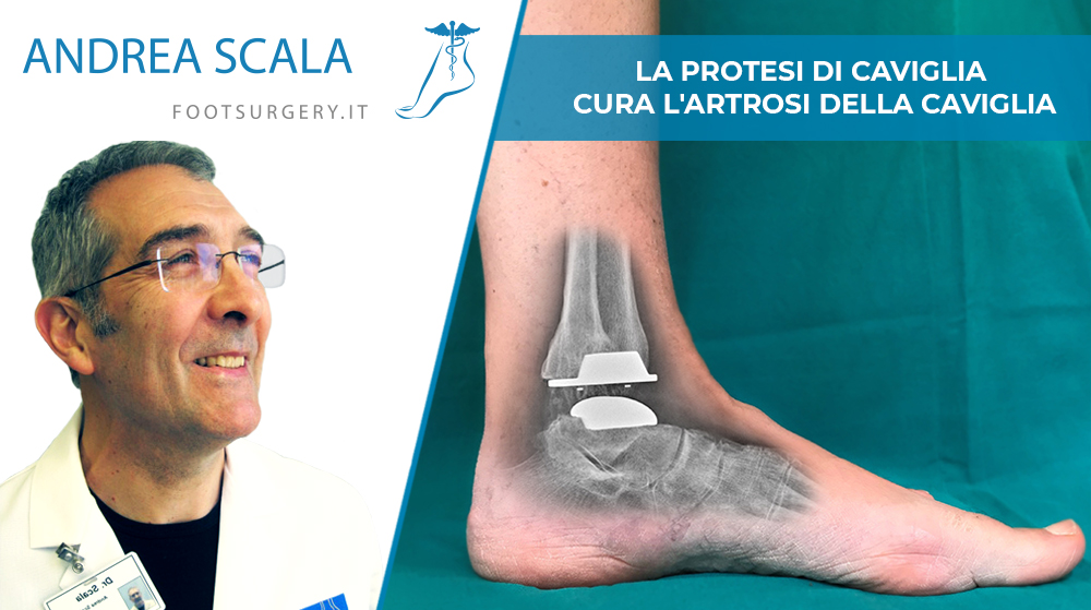 La protesi di caviglia cura l’artrosi della caviglia.