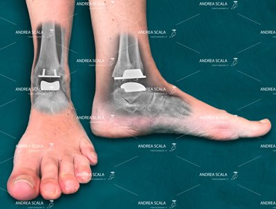 protesi-caviglia-dott-scala