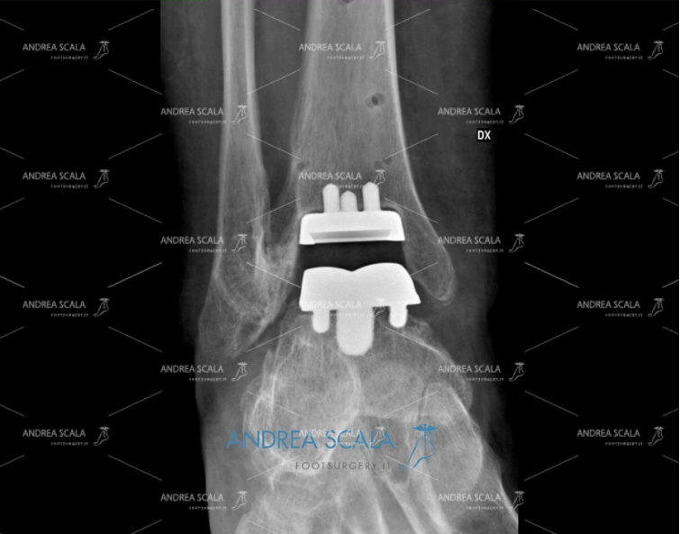 ARTRODESI anteriore dopo alcuni mesi