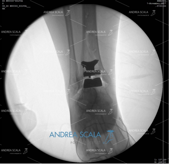 ARTRODESI radiografia anteriore protesi caviglia
