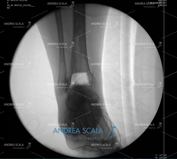 ARTRODESI radiografia anteriore spazio articolare