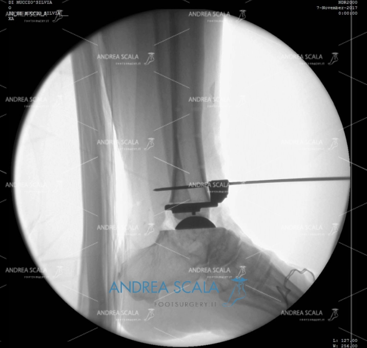 ARTRODESI radiografia laterale protesi caviglia