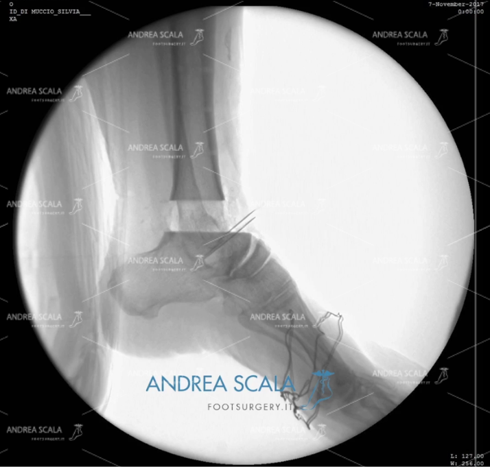 ARTRODESI radiografia laterale senza blocco