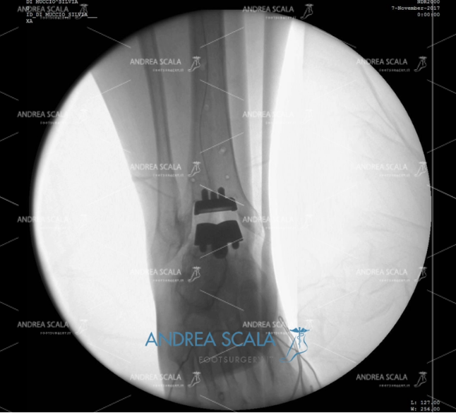 ARTRODESI radiografia protesi definitiva