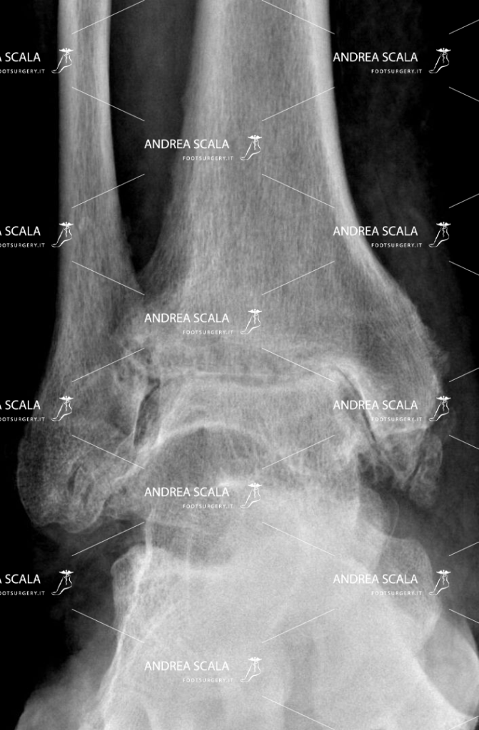 Artrosi della caviglia