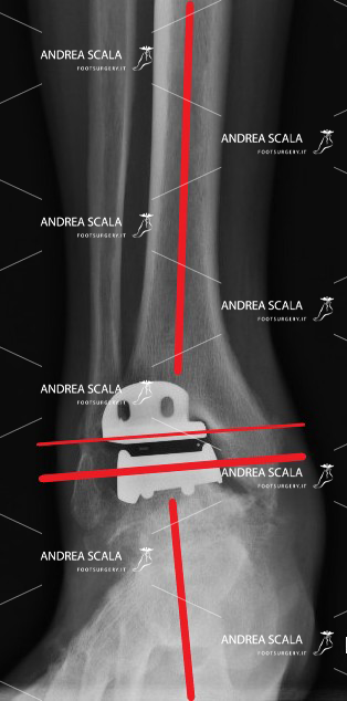 La protesi di caviglia