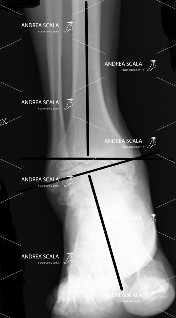 La protesi di caviglia